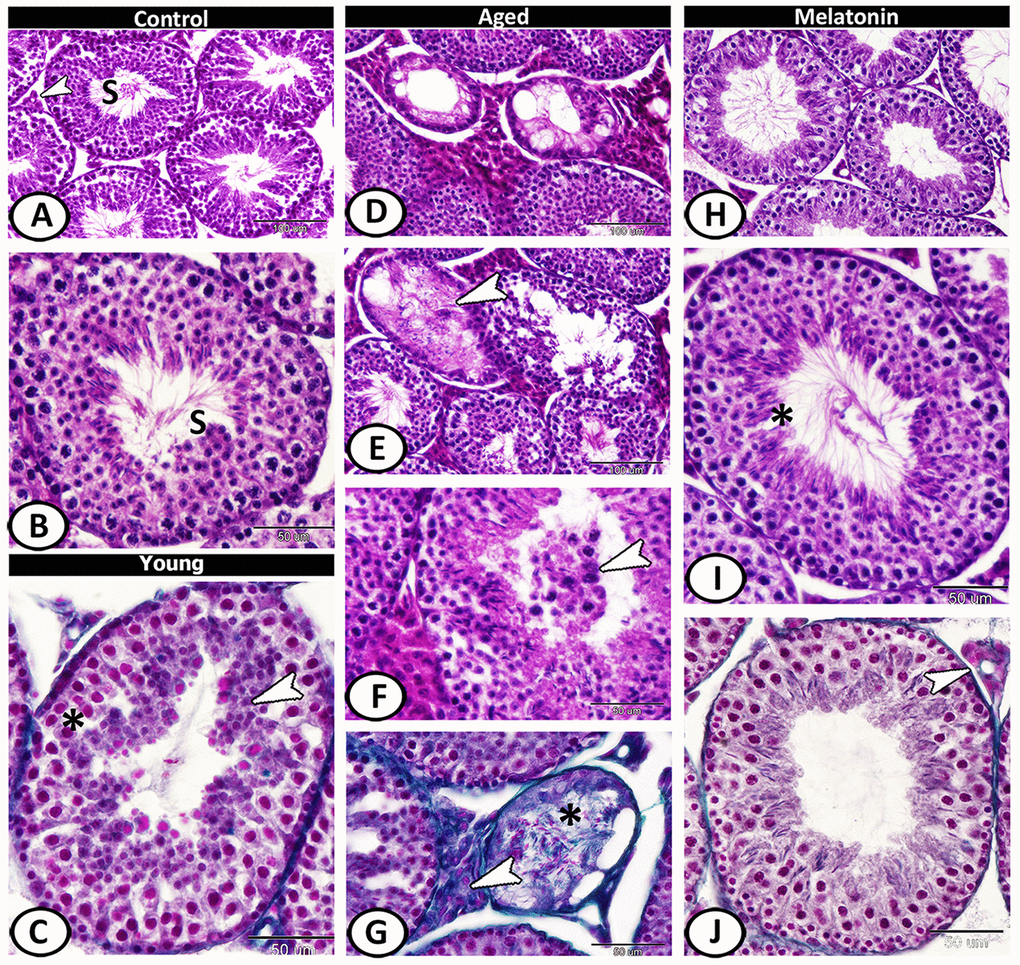 Histological pattern of spermatogenesis in young and aged mice stained with HE except for C, G, J are stained with Crossmon's trichrome. (A, B) Seminiferous tubules of the control group characterized by normal spermatogenesis (S). Note, a narrow interstitium contained interstitial cells (arrowhead). (C) Seminiferous tubules in young mutant mice characterized by pyknosis (asterisk) in the spermatogenic epithelium with spermatids aggregation (arrowhead). (D) In aged mice, a mosaic pattern of seminiferous tubules ranged from tubules with complete, reduced spermatogenesis to degenerated tubules. (E) Clusters of vacuoles and absence of mitotic cells among the epithelium of seminiferous tubules with apparent degeneration, and absence of sperms in many tubules of aged mice (arrowhead). (F) The lumen of seminiferous tubules contained spermatids and spermatocytes (arrowhead). (G) The volume of interstitial tissue increased with an abundance of collagen fibers (arrowhead). Note sclerosed tubule (asterisk) that showed loss of spermatids. (H–J) In melatonin group, enhanced spermatogenesis, presence of many sperms (asterisk) and normal interstitial tissues (arrowhead) demonstrated.