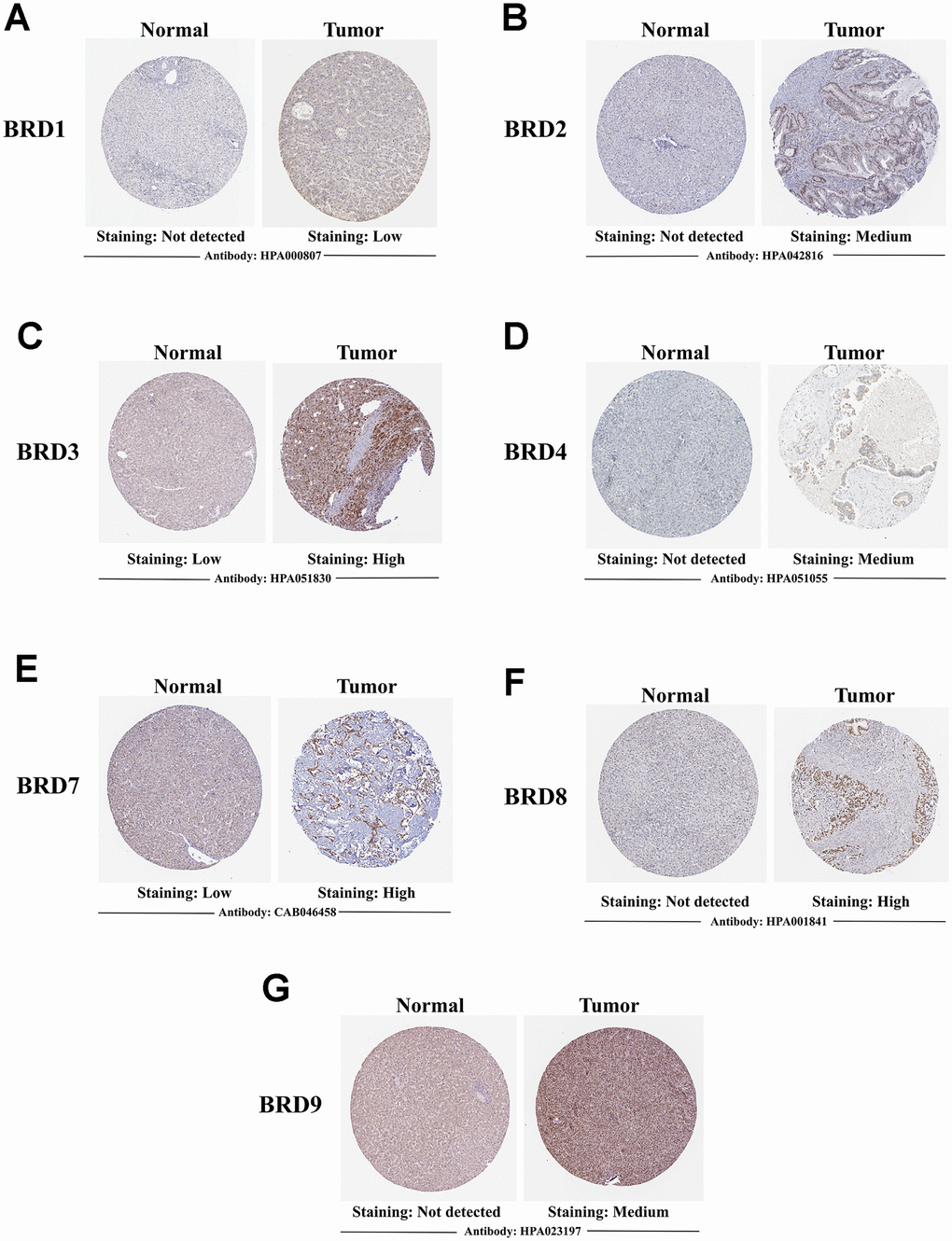 Representative immunohistochemistry images of 7 distinct BRD-containing proteins in HCC tissues and normal liver tissues (Human Protein Atlas). BRD1/2/4/8/9 were not expressed in normal liver tissues, while their low and medium protein expressions were observed in HCC tissues (A, B, D, F, G). Low expressions of BRD3/7 were observed in normal liver tissues, while their medium and high protein expressions were found in HCC tissues (C, E).
