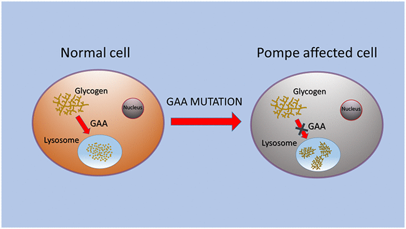 Schematic representation of GAA alteration that caused glycogen storage in lysosomes of PD cells.