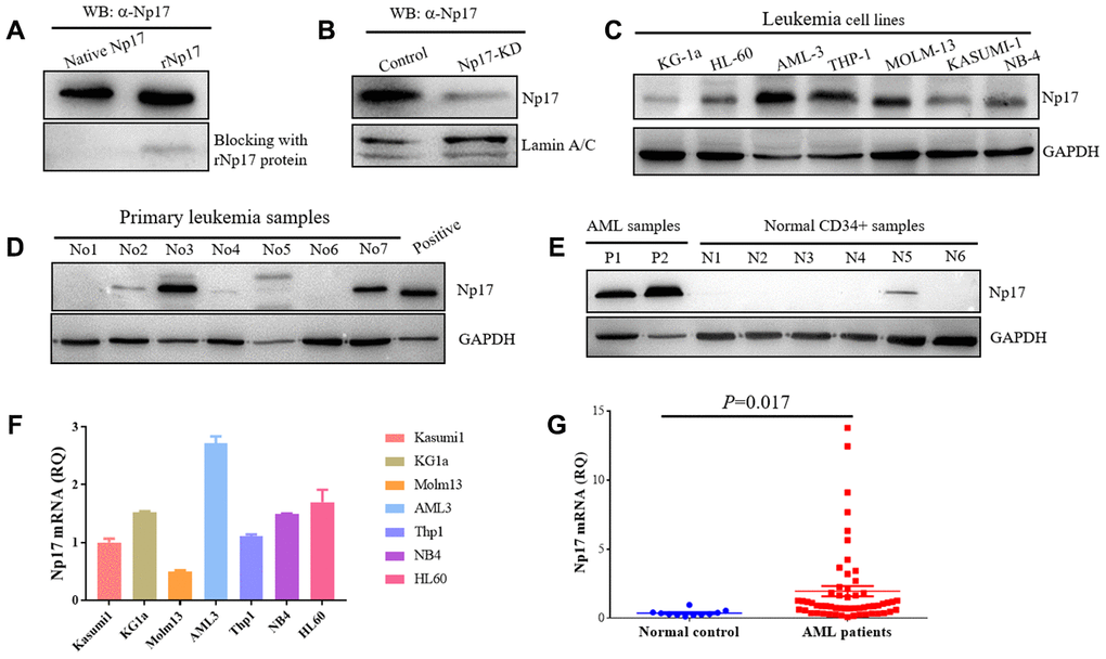 Human leukemia cells express native Np17 protein and mRNA. (A) Western blot detection of native Np17 protein from a primary leukemia sample with Np17 antibody (α-Np17) and was blocked with recombinant Np17-6xHis protein (rNp17 protein). (B) Knock-down of Np17 with shRNA against Np17 significantly reduced nuclear Np17 protein level in THP-1 leukemia cells. (C) Western blot detection of native Np17 protein in human leukemia cell lines. (D) Western blot detection of native Np17 protein in primary human leukemia samples, the recombined Np17 protein of 293T cells was set as positive control. (E) Native Np17 protein was also detected in normal hematopoietic stem cells (CD34+ samples) but its level was lower as compared with AML samples (P1, P2). (F, G) detection of Np17 mRNA in human leukemia cell lines (F) and AML patient samples (G) with qRT-PCR.