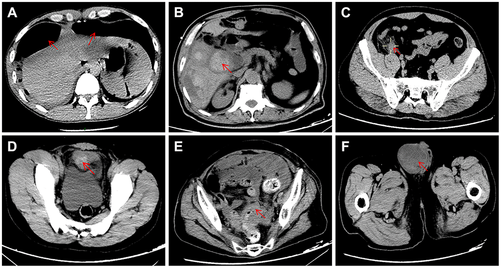 Typical appearance of abdominal CT showing the causes of acute abdomen in the present study. (A) duodenal perforation accompanied by free intraperitoneal gas; (B) gangrenous cholecystitis; (C) acute appendicitis; (D) bladder rupture; (E) intestinal obstruction caused by carcinomas in the rectosigmoid junction; (F) intestinal obstruction caused by inguinal incarcerated hernia.