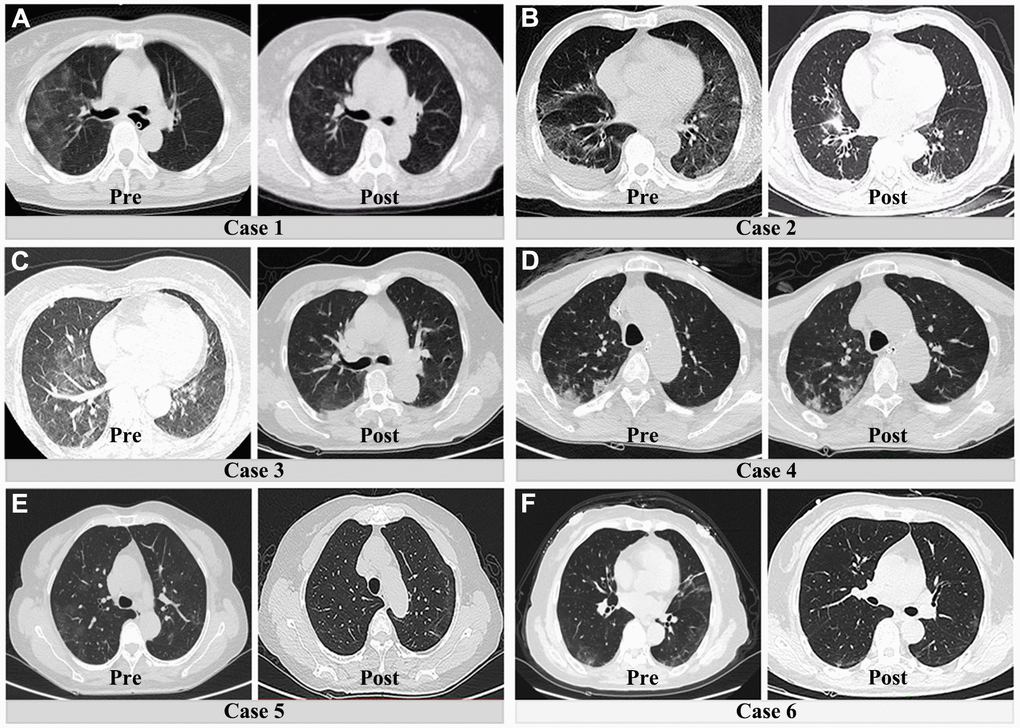 Preoperative and postoperative CT lung manifestations in six patients with both acute abdomen and COVID-19 pneumonia. (A–C) and (E, F) show the obvious resolution of pulmonary inflammation. The fourth patient had no significant change of pulmonary inflammation after surgical treatment (D).