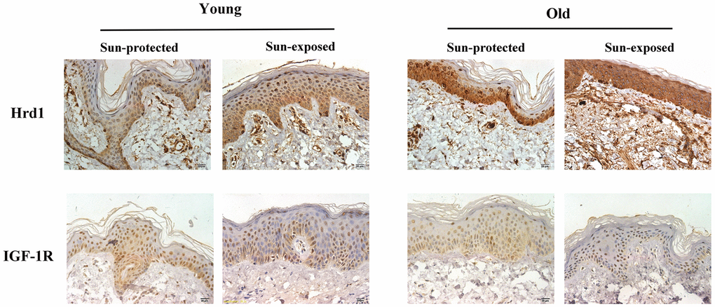The expressions of Hrd1 and IGF-1R by immunohistochemistry in clinical patients.