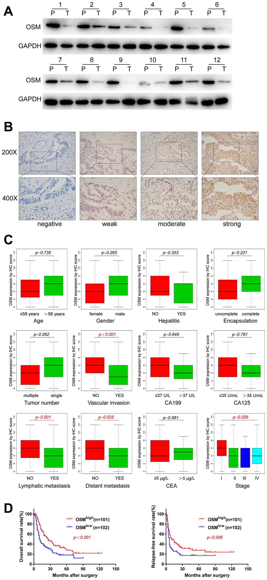 OSM Expression Level in CCA And the Correlations with Clinical Characteristics. (A) The protein expression of OSM in 12 paired CCA tumor (T) and adjacent non-tumor tissues (P) by western blotting. (B) Representative immunostaining images of OSM in CCA. (C) Boxplots depicted the correlation of OSM expression level and clinical characteristics; (D) Overall survival and relapse-free survival of OSMhigh and OSMlow groups evaluated by IHC;