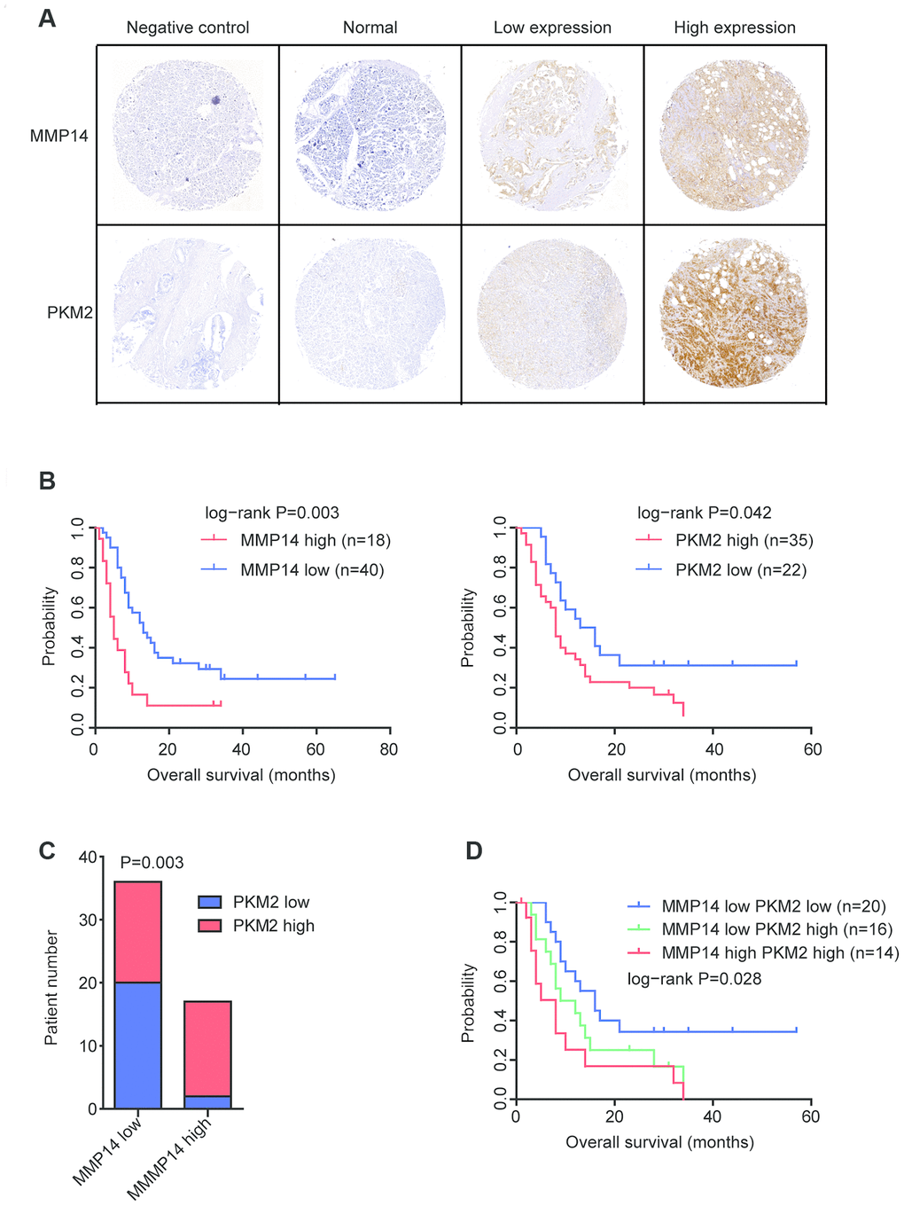 Validation of the expression and prognostic significance of MMP14 and PKM2 in pancreatic cancer by tissue microarray. (A) Representative photographs of immunohistochemical features of the stained sections of MMP14 and PKM2 in pancreatic cancer tissues and adjacent normal tissues. (B) Kaplan-Meier survival analysis was used to determine the different overall survival of pancreatic cancer patients with highly stained MMP14 or PKM2 (red) and pancreatic cancer patients with low stained MMP14 or PKM2 (blue). P values were generated from Log-rank test. (C) Contingency graphs showed the number of pancreatic cancer patients with both high MMP14 and PKM2 expression. P values were determined by Chi-square test. (D) Kaplan-Meier plotters demonstrated the different overall survival of pancreatic cancer patients with different expression levels of MMP14 and PKM2.