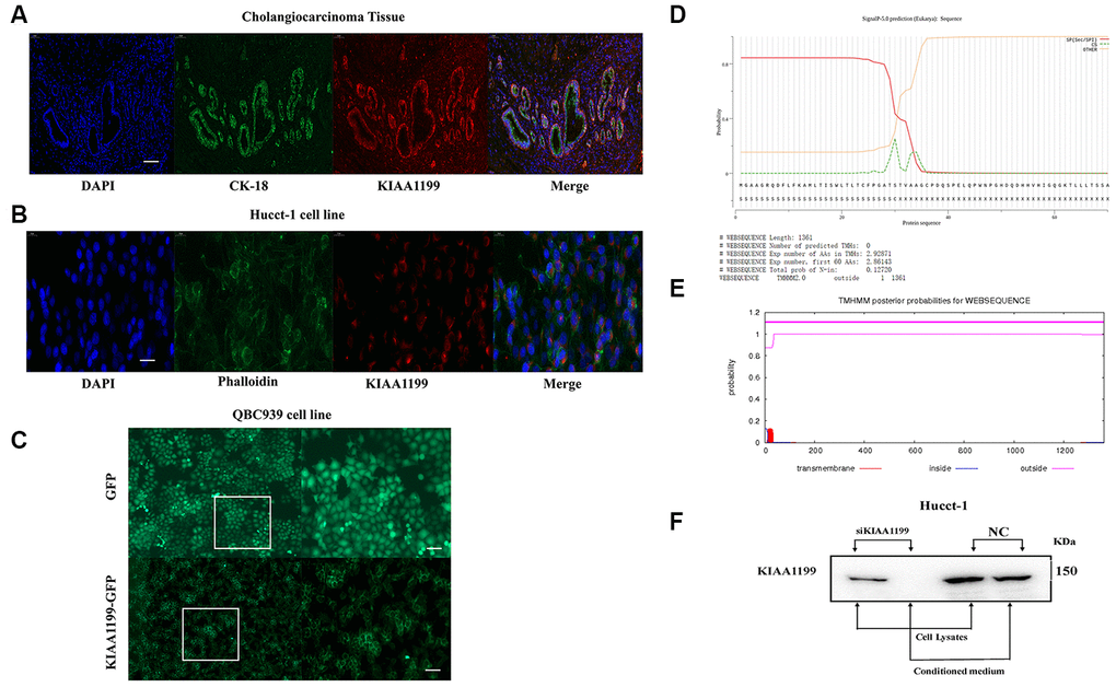 (A) Immunofluorescence localization of KIAA1199 and CK-18 in cholangiocarcinoma tissue (red, KIAA1199; green, CK-18; blue, DAPI). (B) Immunofluorescence localization of KIAA1199 and Phalloidin in Hucct-1 cell line (red, KIAA1199; green, Phalloidin; blue, DAPI). (C) Microscopic determination of KIAA1199 cellular localization using QBC939 cells transfected with green fluorescent protein (GFP), KIAA1199-GFP chimeric cDNAs. (D) KIAA1199 had signal peptides. (E) KIAA1199 has 602 amino acids, all of which are extracellular, and there is no transmembrane domain (TMD). (F) Western blot analysis was performed to detect KIAA1199 in cell lysates and conditioned culturing medium from Hucct-1 and Hucct-1 knockdown KIAA1199 (siKIAA1199).