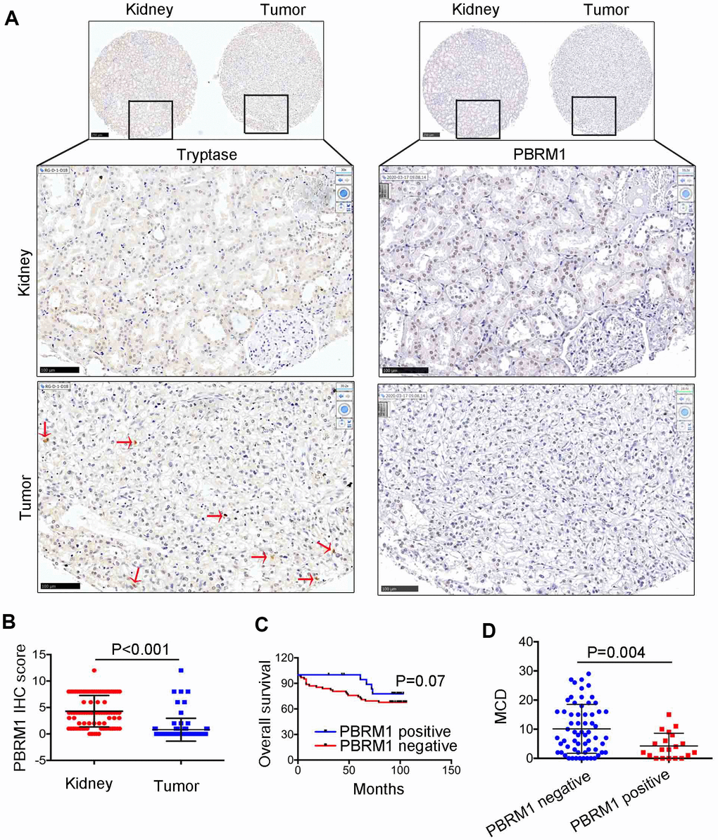 The relationship between PBRM1 protein expression and mast cell infiltration in ccRCC based on IHC analysis. (A) Representative immunohistochemical images show PBRM1- and tryptase-positive mast cells in ccRCC and adjacent normal kidney tissue samples. (B) Dot plot of PBRM1 IHC staining score in adjacent normal kidney tissues (n=83) and ccRCC tissues (n=83). (C) Overall survival of ccRCC patients with PBRM1 IHC staining negative group (n=65) or PBRM1 IHC staining positive group (n=20). (D) Pearson correlation analysis shows the association between PBRM1 expression and mast cell infiltration in 85 out of 90 ccRCC patient tumor tissue samples. Data for five tumor tissues is not included (missing the tissues in TMA). Note: Statistical significance was based on Student’s t-test.