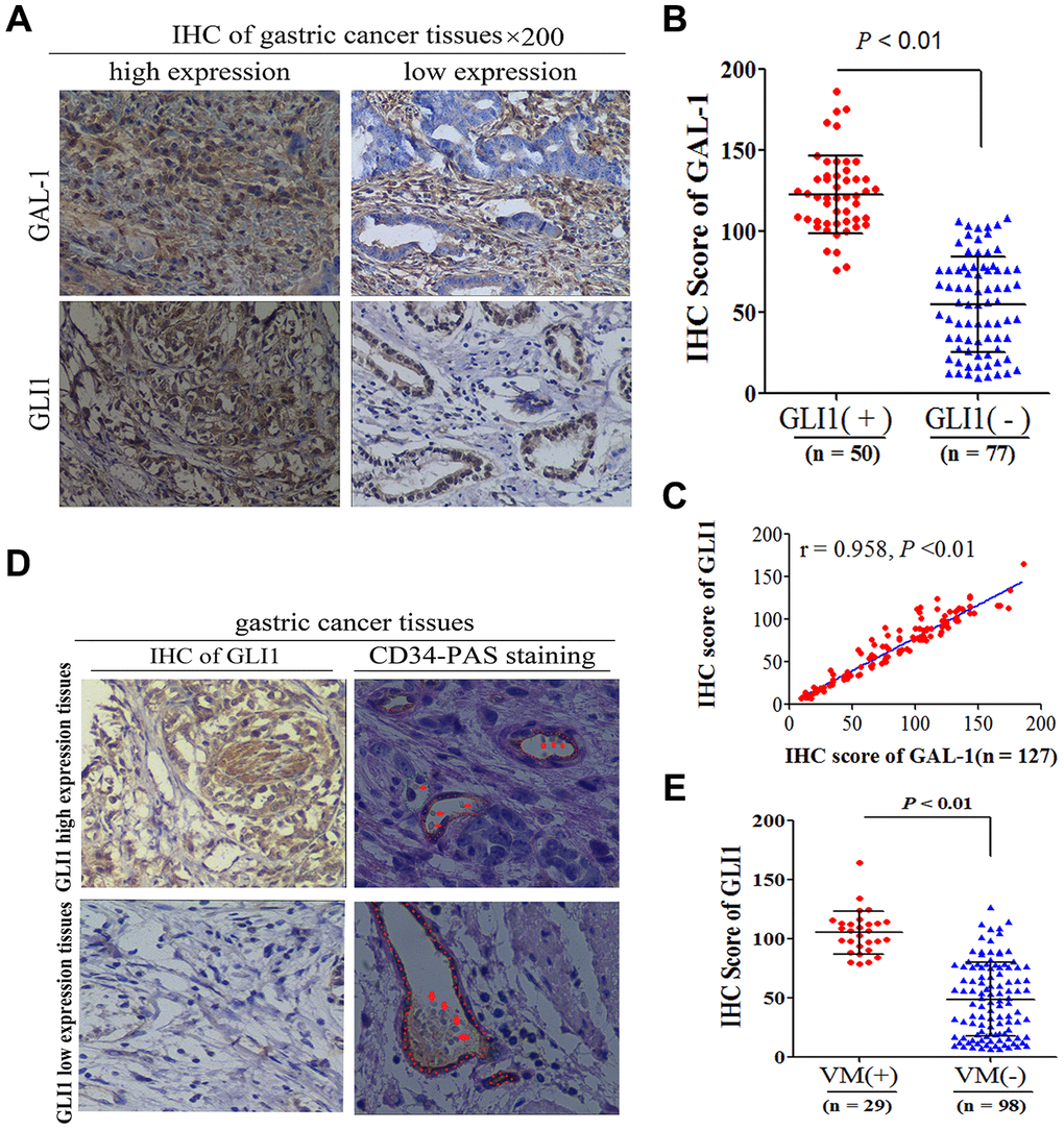 GAL-1 expression is correlated with GLI1, and GLI1 expression is correlated with VM. (A) Representative images of IHC indicating GLI1 and GAL-1 protein expression in GC tissues (×200 magnification). (B) The GAL-1 IHC scores in GLI1-positive GC tissues were significantly higher than the GAL-1 IHC scores in GLI1-negative GC tissues(P C) GAL-1 IHC scores were positively correlated with GLI1 IHC scores in GC tissues (r = 0.958; P D) GC tissues exhibiting high GLI1 expression were more likely to form VM (endogenous cell-dependent vessels are indicated by the red dotted line, VM is indicated by the green dotted line, and red blood cells are indicated by red arrows in VM and endogenous cell-dependent vessels; ×400 magnification). (E) The GLI1 IHC scores in GC tissues with VM were significantly higher than those without VM (P 