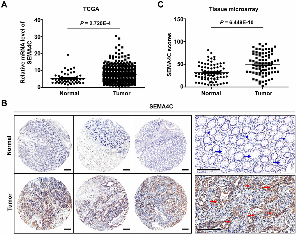 SEMA4C mRNA and protein levels are upregulated in the CRC tissues. (A) The relative SEMA4C mRNA expression level in normal colorectal and CRC tissues from the TCGA-COAD and TCGA-READ datasets. (B) Representative micrographs show SEMA4C immunohistochemical staining of the 83 pairs of colon cancer and adjacent normal colon tissue samples in the tissue microarray (TMA). Note: Scale bars=200 μm; red arrow indicates strong positive SEMA4C protein expression in the colon cancer tissue; blue arrow indicates negative SEMA4C protein expression in the adjacent normal tissue. (C) Quantitative analysis of SEMA4C protein expression scores based on the immunohistochemical staining of the TMA with 83 pairs of colon carcinoma and adjacent normal colon tissue samples.