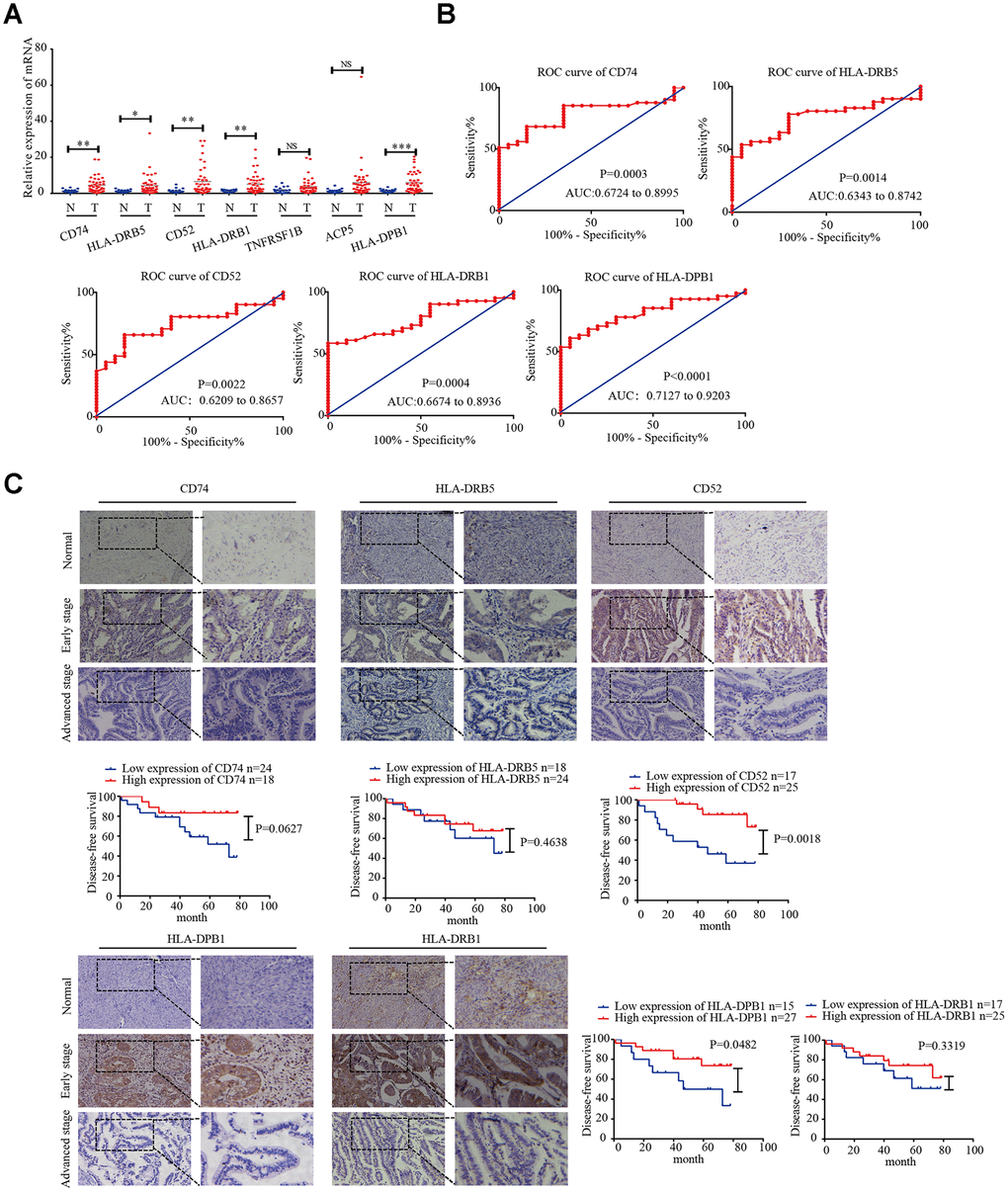 CD74, HLA-DRB5, CD52, HLA-DPB1, and HLA-DRB1 in the microenvironment of related prognostic markers in endometrial cancer. (A) Expression of CD74, HLA-DRB5, CD52, HLA-DPB1, HLA-DRB1, TNFRSF1B, and ACP5 in 41 endometrial cancer tissues and 20 normal tissues was determined by qRT-PCR. (B) ROC curve of 5 msicroenvironment-related prognostic signature. (C) Expression of CD74, HLA-DRB5, CD52, HLA-DPB1 and HLA-DRB1 was detected by immunohistochemistry in endometrial cancer (n = 42) and normal endometrial tissue (n = 20). Disease-free survival curves for CD74, HLA-DRB5, CD52, HLA-DPB1 and HLA-DRB1 in 42 endometrial carcinoma cases. *P P P 
