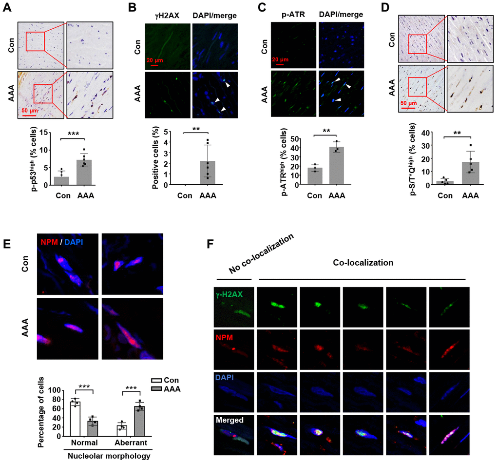 Increases in nucleolar stress response, p53 phosphorylation and DNA damage response in human AAA tissues. (A) Immunohistochemical staining and semi-quantitative data showing the increased level of p53 phosphorylation in the medial layer of normal (Con) and AAA aortas (n = 6). (B) Immunofluorescence results showing the increased number of γH2AX foci (arrowheads) in AAA tissues (n = 6). (C) Immunofluorescence results showing the increased number of cells exhibiting a high level of ATR phosphorylation (arrowheads) in AAA tissues (n = 3). (D) Immunohistochemical staining and semi-quantitative data showing the increased level of phospho-S/T*Q motif of ATM/ATR substrates in AAA tissues (n = 5). (E) Immunofluorescence images of NPM staining showing medial cells with normal nucleoli morphology (examples from control aortas) and those with aberrant nucleoli morphology (highly diffused NPM fluorescence signal) (examples from AAA tissues). The quantitative data below showed the proportions of cells with normal and aberrant nucleoli morphology in control and AAA aortas (n = 4). (F) Example images of AAA medial cells positive for γH2AX foci showing non-co-localization and co-localization of γH2AX with NPM. Dot blot-combined bar graphs represented mean ± S.D. ** P P t-test.