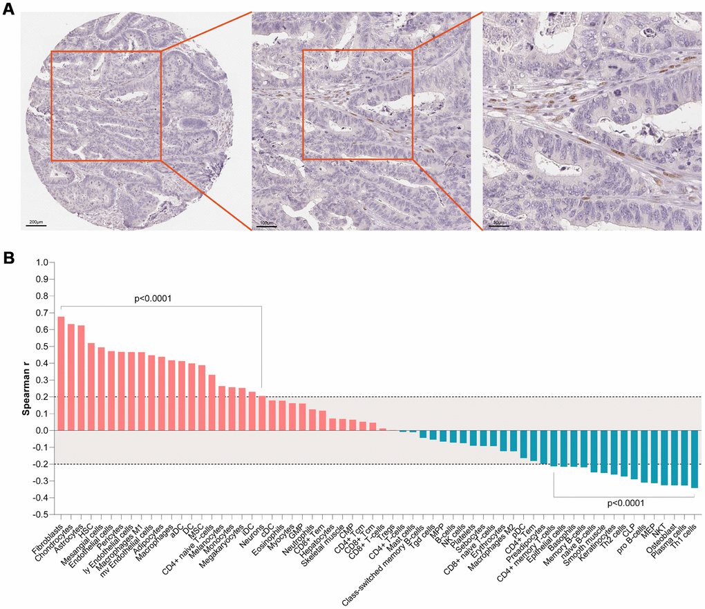 (A) IHC staining indicated that SMARCD3 was mainly expressed colon cancer associated fibroblasts. (B) SMARCD3 expression was most associated with fibroblasts by ssGSEA analysis.