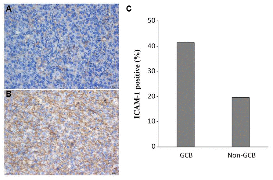 ICAM-1 expression in DLBCL patients. Representative immunohistochemical staining of ICAM-1 with negative (A) and positive (B) expression. (C) Overexpression of ICAM-1 in GCB and non-GCB subtypes.