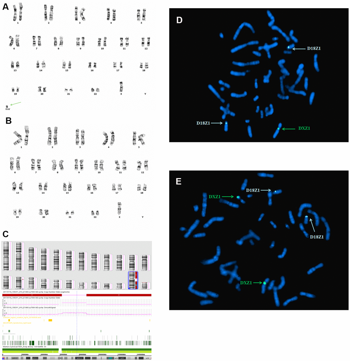 Prenatal Diagnosis And Molecular Cytogenetic Identification Of Small ...