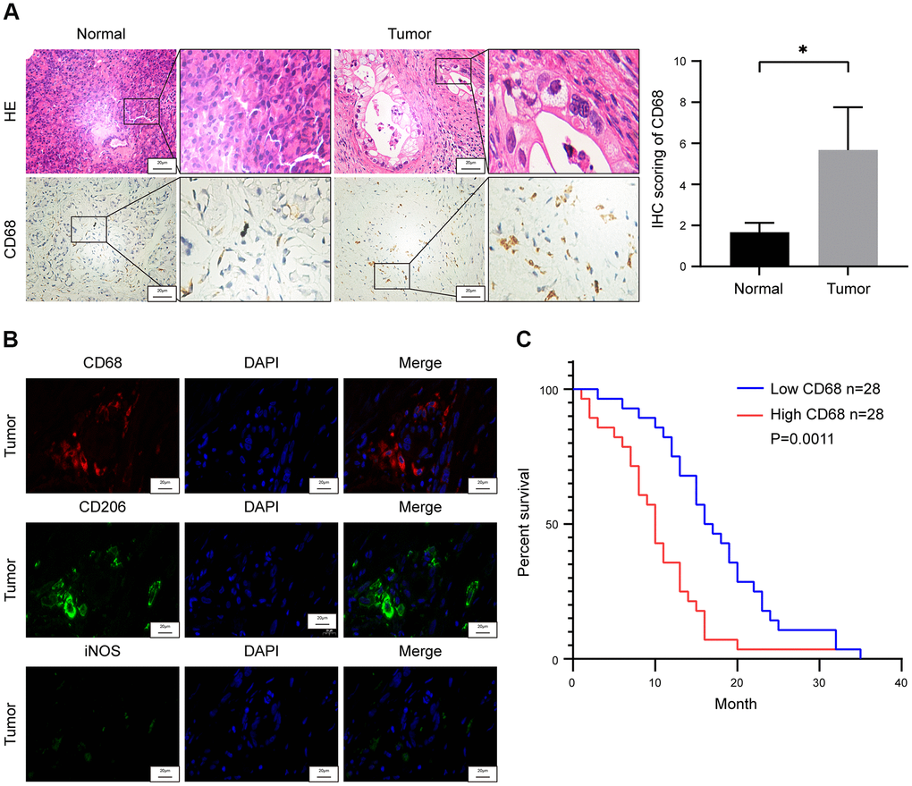 Tumor-associated macrophage (TAM) density correlates with survival outcomes in pancreatic ductal adenocarcinoma (PDAC) patients. (A) Representative images show hematoxylin and eosin (H&E) and CD68 stained PDAC and adjacent normal pancreatic tissues. Note: n = 3; Scale bar = 20 μm; *P B) Representative fluorescence staining images show CD68, iNOS and CD206 expression in PDAC and adjacent normal pancreatic tissues. Scale bar = 20 μm. (C) Kaplan-Meier survival curve analysis shows overall survival rates of CD68-high (n = 28) and CD68-low (n = 28) expressing PDAC patients from Ruijin Hospital (log-rank test: P 