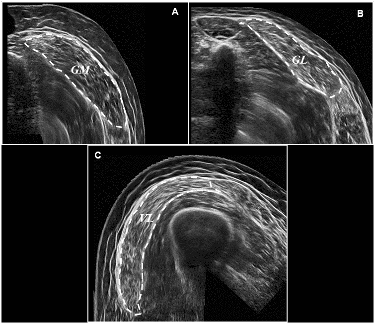 Representative ultrasound images following panoramic ultrasound imaging. Panel (A) represents a transverse image of GM CSA (outlined for effect) at 50% of muscle length, Panel (B) represents a transverse image of GL CSA (outlined for effect) at 50% of muscle length, and Panel (C) represents a transverse image of VL CSA (outlined for effect) also at 50% of muscle length.