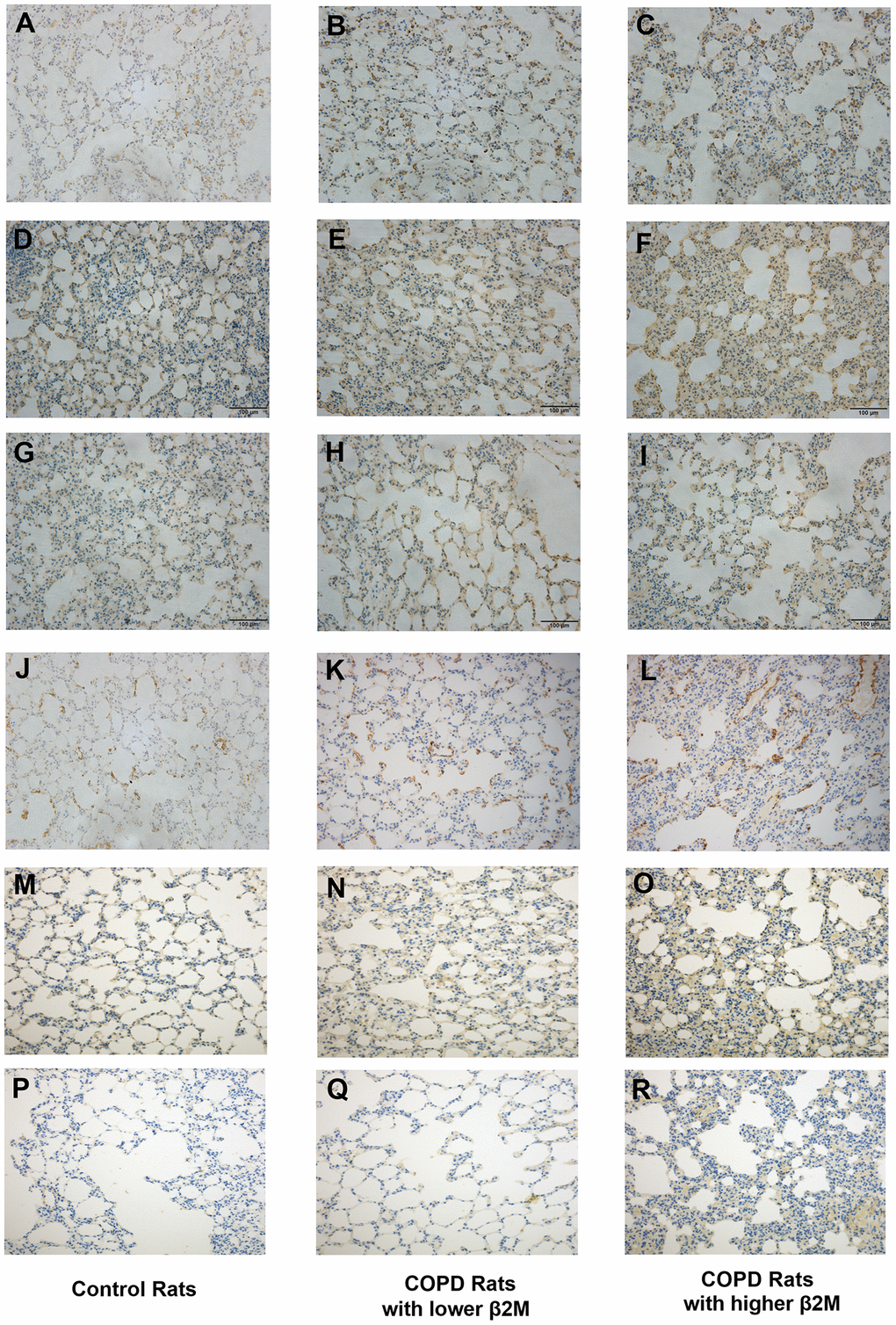 Immunohistochemical staining of lung tissue from rats. Lung tissue of control rats including (A, D, G, J, M, P); lung tissue of COPD rats with lower β2M including (B, E, H, K, N, Q); lung tissue of COPD rats with higher β2M including (C, F, I, L, O, R). Indicators and positive cell rate: (A–C) Representative image of β2M immunohistochemical staining of lung tissue from control rats (7.29 ± 1.65%), COPD rats with lower β2M (14.39 ± 2.17%) and COPD rats with higher β2M (21.21 ± 2.56%) respectively. (D–F) Representative image of TGF-β1 immunohistochemical staining of lung tissue from control rats (30.12 ± 3.24%), COPD rats with lower β2M (33.22 ± 2.87%) and COPD rats with higher β2M (37.30 ± 4.99%) respectively. (G–I) Representative image of Smad4 immunohistochemical staining of lung tissue from control rats (20.67 ± 2.25%), COPD rats with lower β2M (27.04 ± 2.99%) and COPD rats with higher β2M (29.51 ± 3.14%) respectively. (J–L) Representative image of a-SMA immunohistochemical staining of lung tissue from control rats (5.82 ± 0.57%), COPD rats with lower β2M (7.99 ± 1.35%) and COPD rats with higher β2M (9.96 ± 3.10%) respectively. (M–O) Representative image of col1 immunohistochemical staining of lung tissue from control rats (8.43 ± 2.58%), COPD rats with lower β2M (13.19 ± 7.05%) and COPD rats with higher β2M (19.67 ± 7.46%) respectively. (P–R) Representative image of col3 immunohistochemical staining of lung tissue from control rats (12.53 ± 8.96%), COPD rats with lower β2M (12.57 ± 7.06%) and COPD rats with higher β2M (22.04 ± 10.14%) respectively. The pictures show the same differential tendency (P