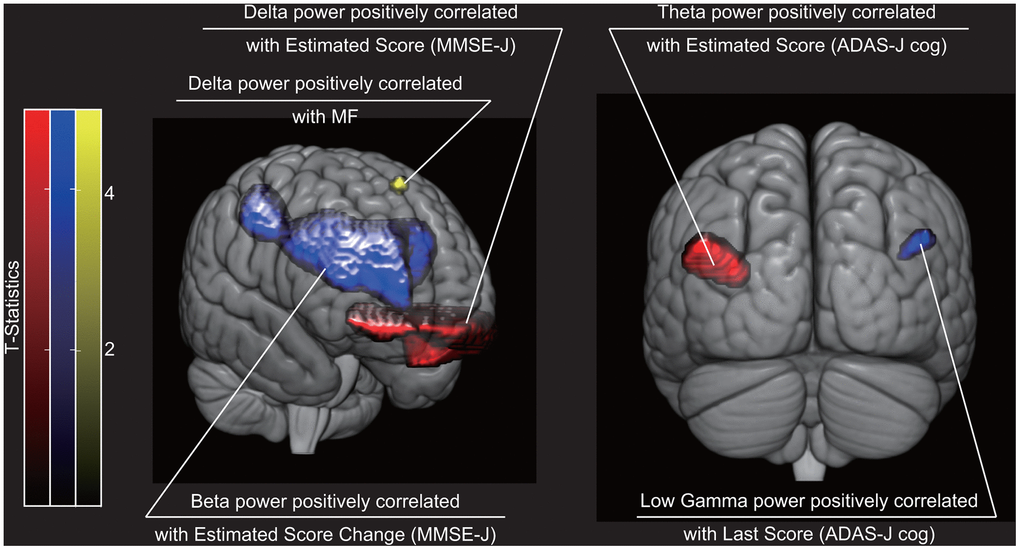 Brain regions where cognitive sores were statistically significantly correlated with regional neural oscillatory intensity. Red indicates brain regions where oscillatory intensity was correlated with cognitive scores on the recording day (i.e. ‘Estimated Scores’). Blue indicates brain regions where oscillatory intensity was correlated with cognitive score change (i.e. ‘Estimated Score Change’) or score at the end of the NPT period (i.e. ‘Last Score). Yellow indicates brain region where oscillatory intensity was correlated with a spectral property. The three dimensional images were created using MRIcroGL (https://www.mccauslandcenter.sc.edu/mricrogl/). NPT, non-pharmacological treatment; MF, median frequency; MMSE-J, Japanese version of the Mini-Mental State Examination; ADAS-J Cog, Japanese version of the Alzheimer's Disease Assessment Scale-Cognitive Subscale.