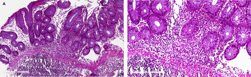 Mycophenolic acid colitis. Histological evaluation at 10x (A) and 20x (B). Colon biopsy retrieved from right colon during diagnostic colonoscopy shows (A) a severe eosinophils and plasma cells infiltrate of the submucosal layer (magnification 10x), (B) confirmed at higher magnification (20x).