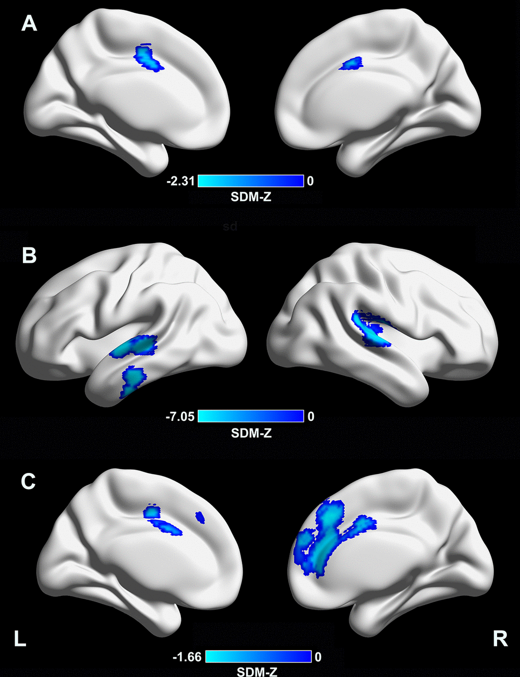 Meta-regression analyses of clinical variables with cortical thickness. (A) A longer disease duration was associated with lower CTh in the supplementary motor area/cingulate cortex (MNI coordinates: x = –4, y = –2, z = 46; BA 24; SDM-Z = –2.31; TFCE-based FWE corrected p = 0.009; voxels = 392). (B) A lower MMSE score in the PD sample was associated with lower CTh in the right superior temporal gyrus/rolandic operculum (MNI coordinates: x = 54, y = –22, z = 12; BAs 48 and 22; SDM-Z = 7.05; TFCE-based FWE corrected p = 0.001; voxels = 999), left superior/middle temporal gyri (MNI coordinates: x = –62, y = –12, z = 0; BAs 48, 21, and 22; SDM-Z = 6.65; TFCE-based FWE corrected p = 0.009; voxels = 441), and left inferior temporal gyrus (MNI coordinates: x = –60, y = –20, z = –24; BAs 20 and 21; SDM-Z = 6.57; TFCE-based FWE corrected p = 0.03; voxels = 169). (C) A higher LEDD in the PD sample was associated with lower CTh in the medial prefrontal cortex/anterior cingulate cortex (MNI coordinates: x = 4, y = 32, z = 38; BAs 32, 24, 10, and 8; SDM-Z = –1.66; TFCE-based FWE corrected p = 0.029; voxels = 1441). CTh, cortical thickness; MNI, Montreal Neurological Institute; BA, Brodmann area; SDM, seed-based d mapping; TFCE, threshold-free cluster enhancement; FWE, family-wise error; PD, Parkinson’s disease; LEDD, levodopa equivalent daily dose.