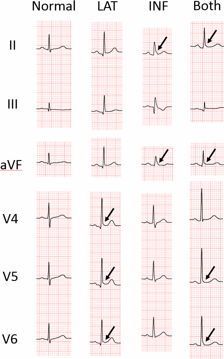 Representative ECGs of individuals with and without early repolarization pattern (ERP). LAT, ERP in lateral leads; INF, ERP in inferior leads; Both, ERP in both inferior and lateral leads. The arrow indicates junction (J)-point elevation greater than 0.1 mV.