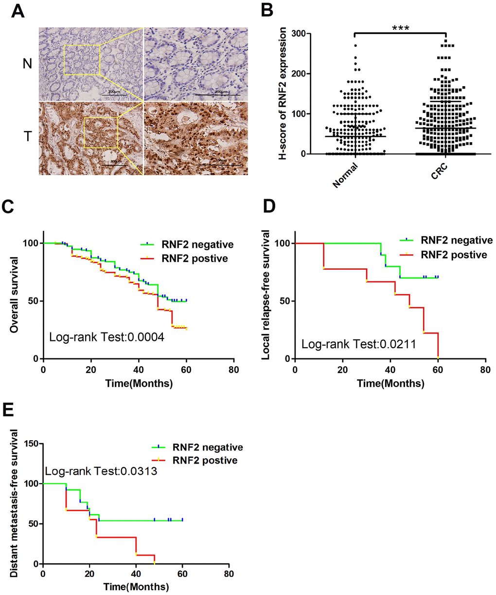 RNF2 expression was upregulated in CRC tumor tissues and was associated with patients’ prognoses. (A) Representative immunohistochemistry results depicting positive and negative RNF2 staining in clinical CRC tumor tissues and adjacent normal tissues. The pictures on the right are the magnified view of the yellow boxes on the left. Scale bar: 200 μm. (B) H-scores for RNF2 expression in 313 CRC tumor tissues and adjacent normal tissues. ***pC) Overall survival of RNF2-positive or -negative CRC patients. (D) Local relapse-free survival of RNF2-positive or -negative CRC patients. (E) Distant metastasis-free survival of RNF2-positive or -negative CRC patients.