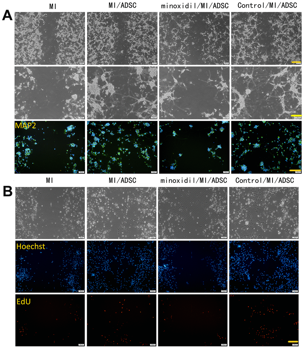 PLOD2 inhibition attenuates ADSC-mediated neuronal protection following mechanical injury in vitro. (A) Light microscopy and MAP2 immunofluorescence imaging of PC12 cells 3 days after ADSC co-culture. Scale bars: 200 μm (upper row), 100 μm (middle and lower rows). (B) EdU assay results showing enhanced proliferation of rat cortical neurons after ADSC co-culture and reduced proliferation in the presence of the PLOD2 inhibitor minoxidil. Scale bar: 100 μm.