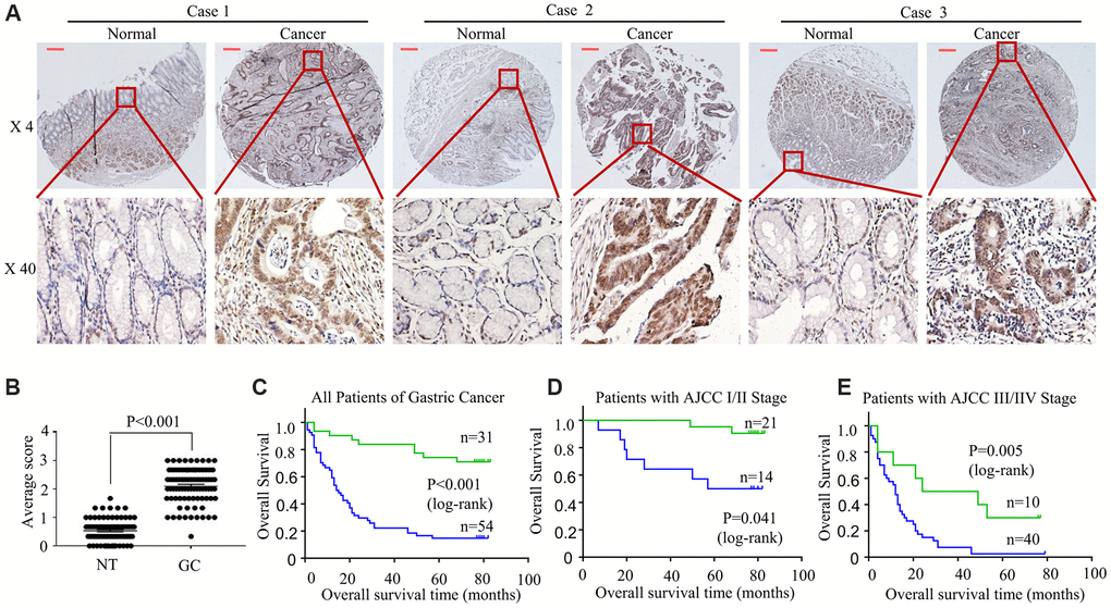 HOXA6 is highly expressed in GC tissues predicted unfavourable prognosis in GC patients. (A) We detected HOXA6 expression in GC tissues and adjacent normal tissues by TMAs. Representative views are shown. (B) HOXA6 protein scores in NT and GC as detected using a TMA-based assay. NT, normal tissue; GC, gastric cancer (C) The overall survival times of 85 patients with GC categorized as “low HOXA6” or “high HOXA6” groups after surgery are compared. (D, E) HOXA6 expression in patients with early-stage GC (D) and late-stage GC (E). Log-rank test was employed to calculate the statistical significance. Scale bars in A represent 25 μm.