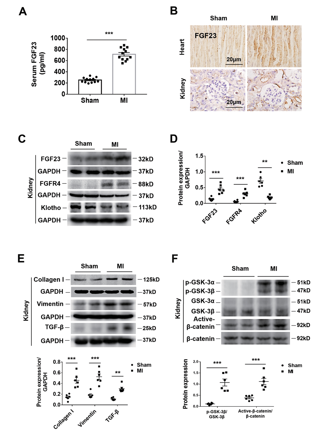 Upregulation of FGF23 in the heart and kidneys and activation of fibrosis-related signaling pathways in the kidneys by cardiorenal syndrome (CRS) at 12 weeks after induction of MI. (A) Serum FGF23 level measured by ELISA. ***P B) Immunohistochemical staining shows enhanced FGF23 Protein expression in the myocardium and renal tubules of CRS mice compared with sham mice. (C) Western blot of FGF23, FGFR4 and Klotho in the kidneys of Sham and CRS mice. (D) Semi-quantitative assessment of FGF23, FGFR4 and Klotho. **P ***P E) Western blot of collagen I, vimentin and TGF-β. **P ***P F) Western blotting reveals significant upregulation of p-GSK-3β and active-β-catenin protein expression in the kidneys of CRS mice. ***P 