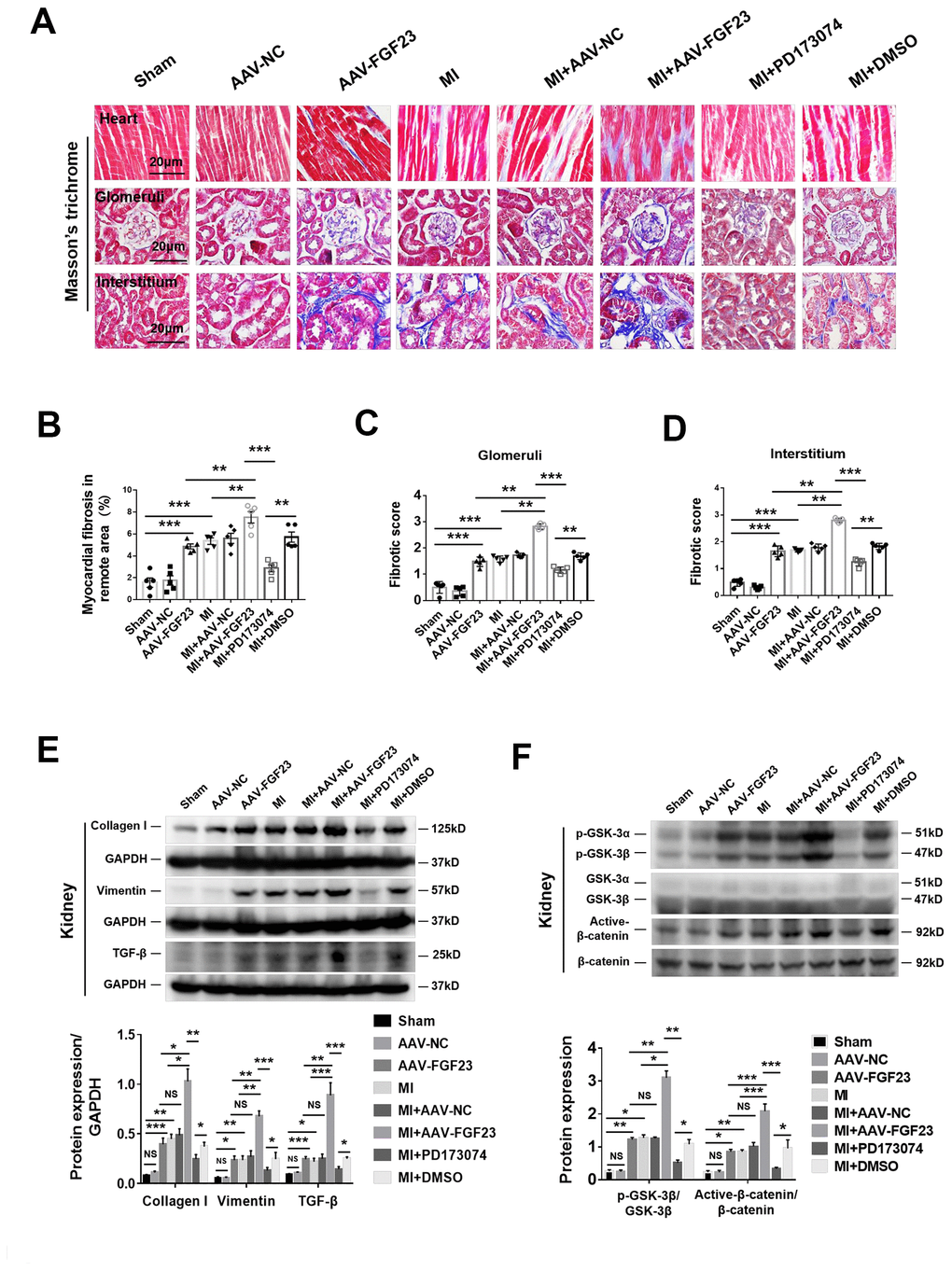 FGF23 overexpression further enhanced cardiac and renal fibrosis, and promoted activation of fibrosis-related signaling pathways in the kidneys of mice with cardiorenal syndrome (CRS). (A) Representative photomicrographs of myocardial and renal fibrosis detected by Masson’s trichrome stain in sham, AAV-NC and AAV-FGF23 mice or CRS mice injected with AAV-NC or AAV-FGF23, or treated with PD173074 or DMSO. (B–D) Semi-quantitative assessment of myocardial, renal glomerular and interstitial fibrosis. (B–D) **P ***P E) Western blot of collagen I, vimentin and TGF-β. (F) Western blot of p-GSK-3β and active-β-catenin. For (E and F), *P **P ***P 
