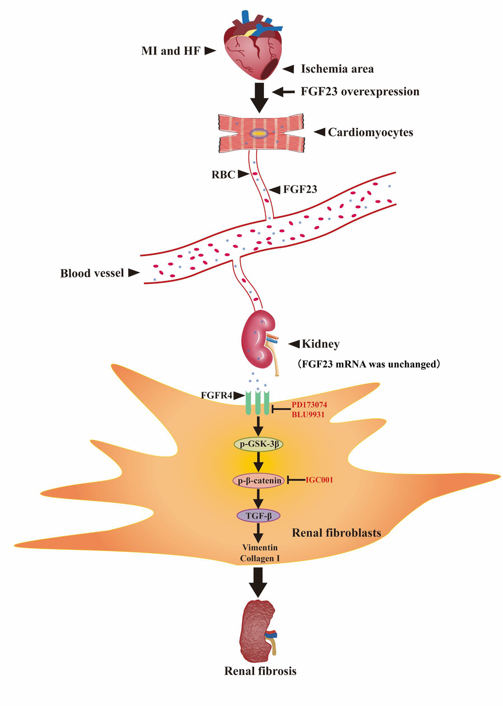 Schematic illustration the contribution of FGF23 induced by post-infarct heart failure to promoting renal fibrosis. Myocardial infarction and heart failure up-regulates FGF23 in cardiomyocytes and increases FGF23 protein level in the kidneys through blood circulation. FGF23 binds FGFR4 in renal fibroblasts and then activates p-GSK3β/p-β-catenin/TGF-β/Vimentin/Collagen I signaling pathway to promote renal fibrosis. Intervention with FGF23 overexpression or FGFR antagonist or β-catenin inhibitor can change the degree of renal fibrosis. MI, myocardial infarction; HF, heart failure; FGF23, fibroblast growth factor 23; RBC, red blood cell; FGFR4, fibroblast growth factor receptor 4; p-GSK3β, phosphorylated glycogen synthase kinase-3 beta; p-β-catenin, phosphorylated beta-catenin; TGF-β, transforming growth factor-beta; PD173074, FGF receptor antagonist; BLU9931: FGFR4 antagonist; IGC001, β-catenin antagonist; ↑, activation; Т, inhibition.