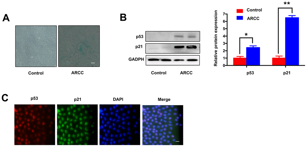 Comparing with controls, LECs aging was increasing in ARCC. (A). The number of SA-β-gal-positive cells increased in LECs of ARCC compared with controls. The senescence of LECs in ARCC was significantly increasing. Scale bar: 50μm. (B). The expression levels of proteins in ARCC and controls were detected by western blot, expression of aging related protein p53 and p21 were higher than controls. **p C). Immunofluorescence showed that p53 and p21 were co-located in the nucleus, while the upstream protein of ATM was located in the cytoplasm in ARCC. with the nuclei staining with DAPI (blue). Scale bar: 50 μm.