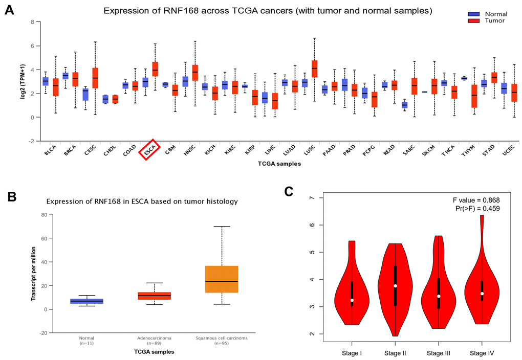 (A) Expression of RNF168 is altered in various types of tumors and is increased in ESCC; (B) RNF168 mRNA expression in ESCC tissues (N=182) and normal esophageal tissues (N=286) (*pC) Expression levels of RNF168 in ESCC tissues from different clinical stages.