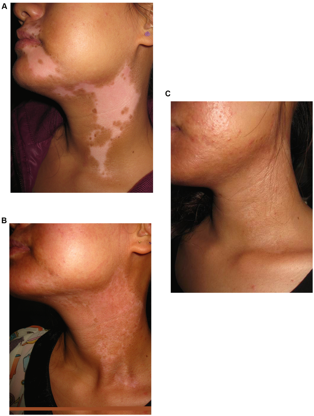 A 20-year old woman with segmental vitiligo on the face and neck. (A) Before surgery. A 20-year old woman with segmental vitiligo on the face and neck. (B) Six months after autologous non-cultured melanocyte-keratinocyte transplantation procedure (MKTP). A 20-year old woman with segmental vitiligo on the face and neck. (C) Twelve months after MKTP with a repigmentation of 100%.