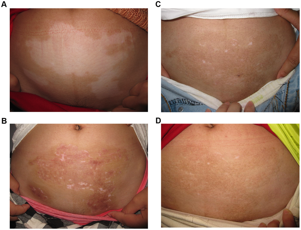 A 28-year old woman with non-segmental vitiligo on the abdomen. (A) Before surgery. A 28-year old woman with non-segmental vitiligo on the abdomen. (B) Three months after autologous non-cultured melanocyte-keratinocyte transplantation procedure(MKTP). A 28-year old woman with non-segmental vitiligo on the abdomen. (C) Six months after MKTP with a regimentation of 98%. A 28-year old woman with non-segmental vitiligo on the abdomen. (D) Twelve months after MKTP with a repigmentation of 98%.
