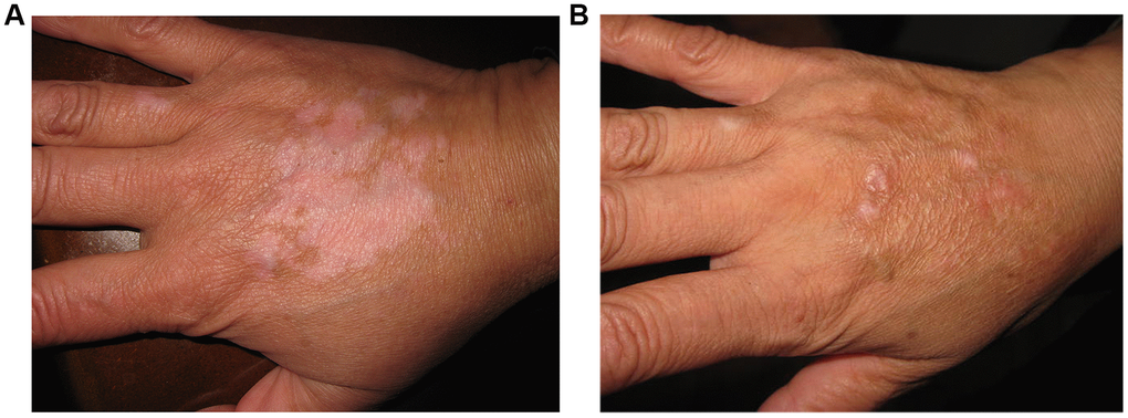 A 29-year old man with non-segmental vitiligo on the back of hand. (A) Before surgery. A 29-year old man with non-segmental vitiligo on the back of hand. (B) Two years after autologous non-cultured melanocyte-keratinocyte transplantation procedure.