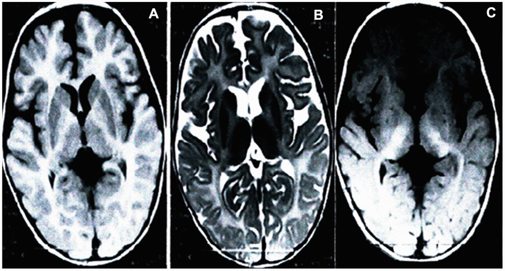 Brain MRI of the proband. Scans showed significantly development delay of white matter, poor myelin formation, close to the level of myelin development in neonates, and reduced volume of white matter throughout the brain. Axial T1-weighted (A), T2-weighted (B) and FLAIR (C).