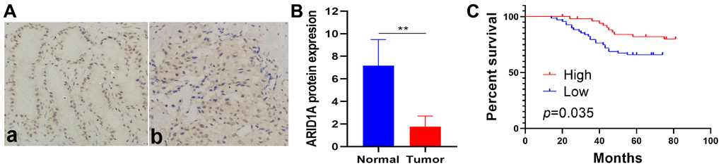 ARID1A protein expression is low and related to poor survival in breast cancer patients. (A) Representative IHC staining of ARID1A in (a) normal tissues (n = 32) and (b) tumor tissues (n = 119) (200×). (B) The expression of ARID1A protein in tumor tissues was significantly lower than that in adjacent normal breast tissues (pC) Low ARID1A expression is associated with poor survival in breast cancer patients, based on a Kaplan–Meier analysis of OS (n=119, log-rank test, p=0.035).