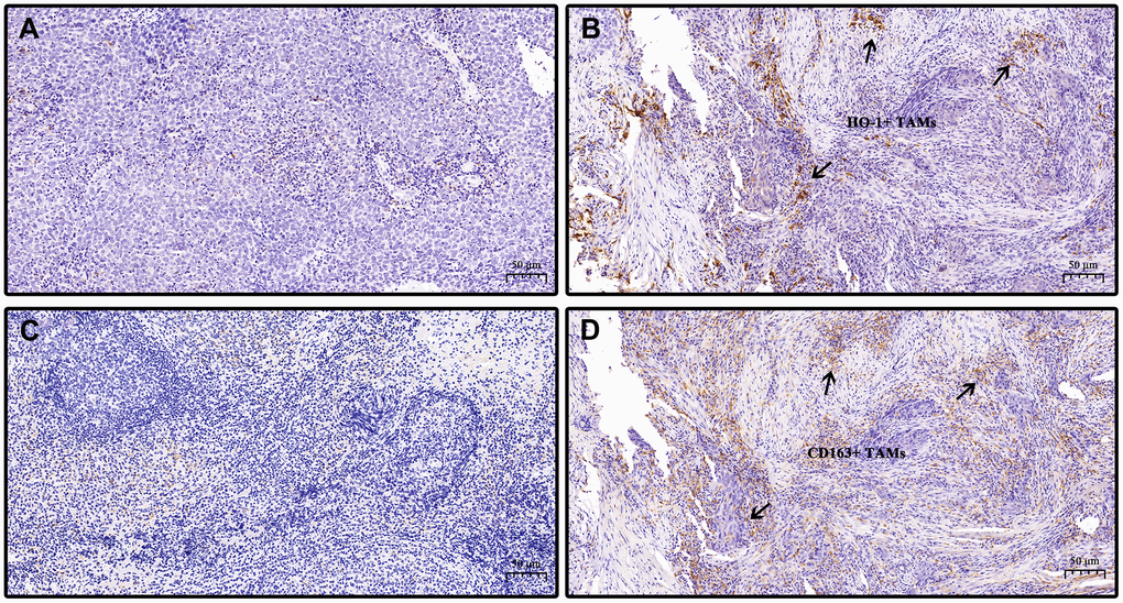Representative specimens showing low and high expression of HO-1 and CD163 in nasopharyngeal carcinoma tissues. Immunohistochemical staining of HO-1 and CD163 are presented. HO-1 and CD163 immunohistochemical scoring: score 0 (no staining), score 1 (weak staining), score 2 (moderate staining), score 3 (strong staining). Staining intensities with scores no greater than 1 were defined as low expression while as high expression when scores are above 1. (A) low expression of HO-1. (B) high expression of HO-1. (C) low expression of CD163. (D) high expression of CD163. (B, D) are from the same section view of tumor specimen of the same patient. Arrows point out co-expression of HO-1 and CD163 in tumor-associated macrophages (TAMs). Scale bar, 50 μm. Magnification, 20×.