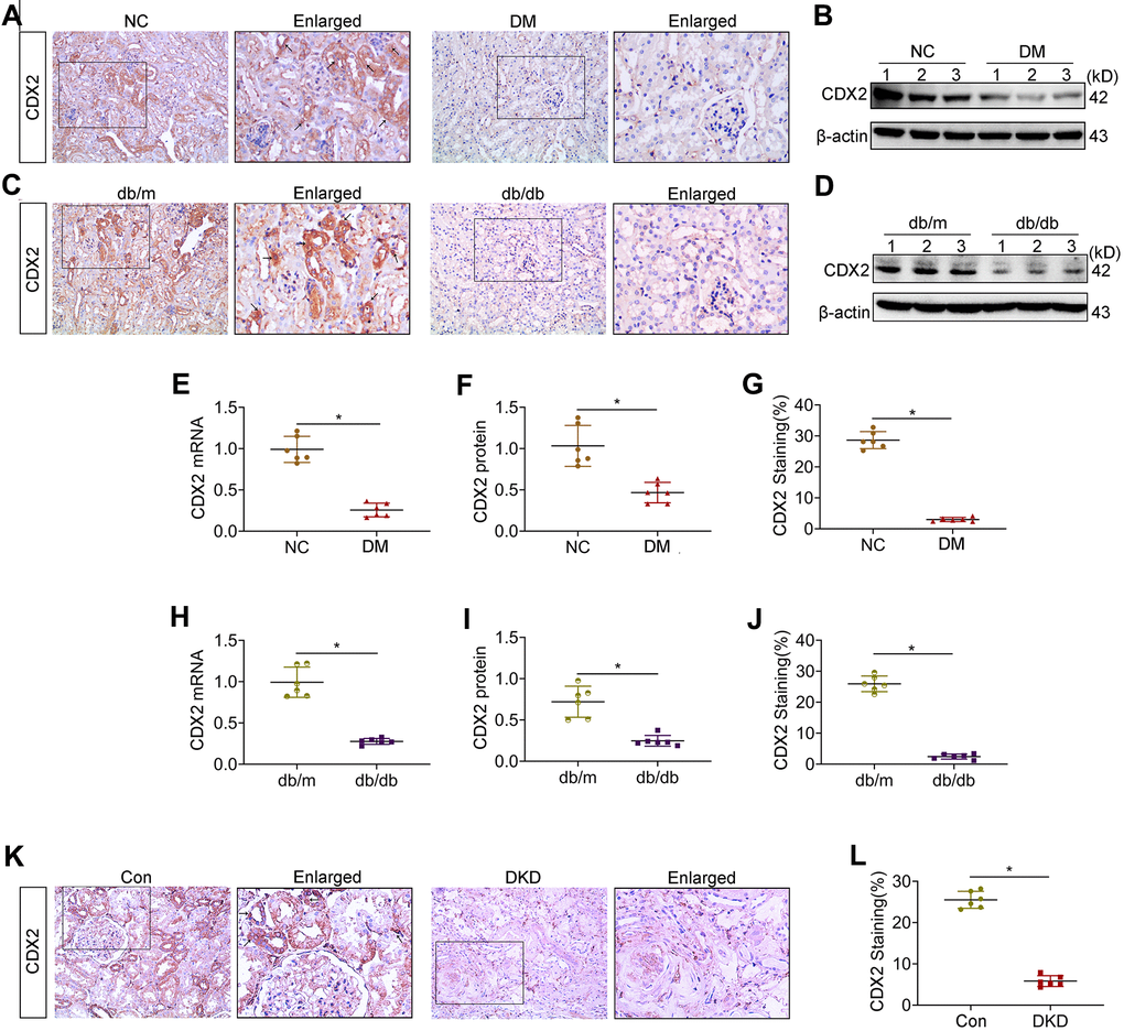 Kidney CDX2 is downregulated in DKD. T1D mice (DM group) and controls were submitted to euthanasia at 16 weeks of age (6 weeks after the establishment of the T1D mouse model), and T2D mice (db/db group) and controls were submitted to euthanasia at 18 weeks of age. (A, B) Immunohistochemical staining (A) and immunoblot (B) for CDX2 detection in T1D mice and controls. (C, D) Immunohistochemical staining (C) and immunoblot (D) for CDX2 detection in T2D mice and controls. (E–G) Immunohistochemical-positive staining density of CDX2 was analyzed in each group from 6 random fields (200×). Quantitation of mRNA amounts (E), Western blot bands (F) and immunohistochemical signals (G) of CDX2 in T1D mice kidney tissues and controls. (H–J) Quantitation of mRNA amounts (H), Western blot bands (I) and immunohistochemical signals (J) of CDX2 in T2D mice kidney tissues and controls. (K, L) Immunohistochemical staining (K) and quantitative analysis (L) of CDX2 in DKD patients kidney tissues and controls. CDX2 is expressed in the cytoplasm and nucleus of renal tubular epithelial cells in the renal cortex (black arrow) (magnification, ×200); enlarged box area (magnification,×400). All data are mean±SD from three independent experiments. n=6; *P