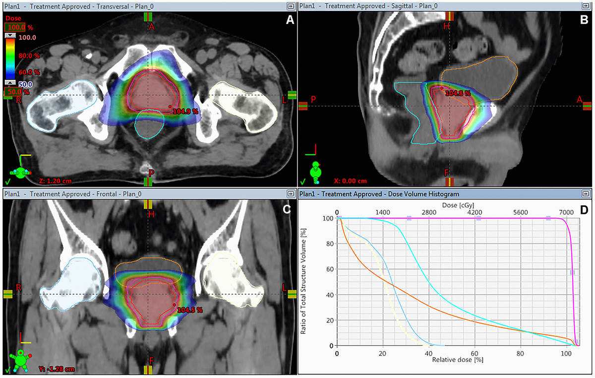 Hypofractionated Versus Conventionally Fractionated Image-guided Volumetric-modulated Arc ...