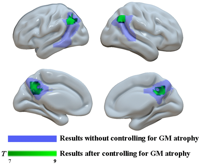 Group differences in18F-FDG SUVR by using whole-brain confirmatory analysis with controlling for GM atrophy between the two groups. Results without controlling for GM atrophy were shown in blue and results after controlling for GM atrophy were shown in green.
