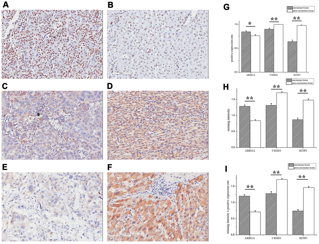 ARID1A, CSMD1, and SENP3 expression differed significantly between tumor and paracarcinoma tissues. The IHC assay images of ARID1A (A, B), CSMD1 (C, D), and SENP3 (E, F) expression. Left images are tumor tissues (A, C, E) and right images are paracarcinoma tissues (B, D, F). (G) The positive expression rates of ARID1A, CSMD1, and SENP3 in tumor and paracarcinoma tissues. (H) The staining intensity of ARID1A, CSMD1, and SENP3 in tumor and paracarcinoma tissues. (I) The staining intensity × positive expression rate of ARID1A, CSMD1, and SENP3 in tumor and paracarcinoma tissues. Immunofluorescence staining, ×200. A paired-samples t-test was performed to test the difference between tumor and paracarcinoma tissues. Data are shown as mean ± SD. **, P 