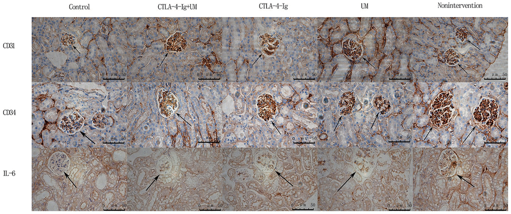 Analysis of renal CD31, CD34, and IL-6 staining. Analysis of renal CD31 staining. Control group: Weakly positive CD31 expression, with no evidence of blood vessel proliferation in the glomerulus (black arrow); CTLA-4-Ig + UM group: Strongly positive CD31 expression, with a small number of blood vessels in the glomerulus (black arrow); CTLA-4-Ig group: Strongly positive CD31 expression, with a small number of blood vessels in the glomerulus (black arrow); UM group: Strongly positive CD31 expression, with significant vascular proliferation in the glomerulus (black arrow); Non-intervention group: Strongly positive CD31 expression, with significant vascular proliferation in the glomerulus (black arrow). Analysis of renal CD34 staining. Control group: Weakly positive CD34 expression, with no evidence of blood vessel proliferation in the glomerulus (black arrow); CTLA-4-Ig + UM group: Strongly positive CD34 expression, with a small number of blood vessels in the glomerulus (black arrow); CTLA-4-Ig group: Strongly positive CD34 expression, with a small number of blood vessels in the glomerulus (black arrow); UM group: Strongly positive CD34 expression, with significant vascular proliferation in the glomerulus (black arrow); Non-intervention group: Strongly positive CD34 expression, with vascular hyperplasia in the glomerulus (black arrow). Analysis of renal IL-6 staining. Control group: Negative IL-6 expression in the glomerulus (black arrow); CTLA-4-Ig + UM group: Weakly positive IL-6 expression in the glomerulus (black arrow); CTLA-4-Ig group: Weakly positive IL-6 expression in the glomerulus (black arrow); UM group: Positive IL-6 expression in the glomerulus (black arrow); Non-intervention group: Strongly positive IL-6 expression in the glomerulus (black arrow).