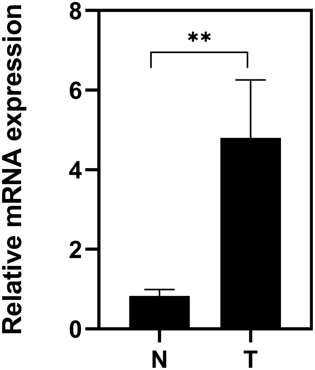 Expression of TACC3 mRNA in KIRC tissues. T: KIRC tissues; N: noncancerous tissues. The results were shown with Mean±SD. N=10, **p