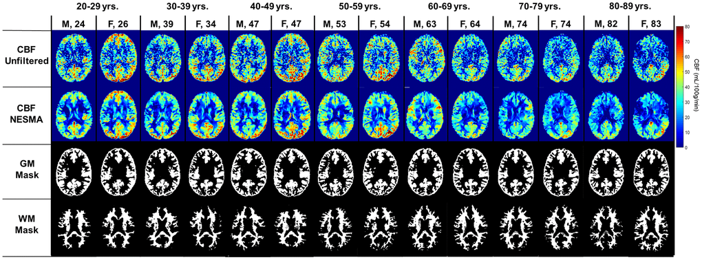 Cerebral blood flow (CBF) maps derived from pCASL imaging datasets with or without the NESMA-ASL filter. Corresponding GM and WM masks generated using FSL-FASL are also displayed. Results are shown for fourteen representative male and female participants within each age decade.
