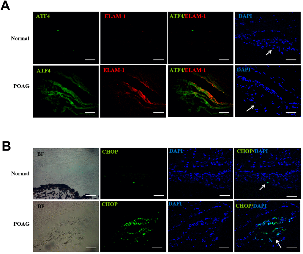 Up-regulation of ATF4, ELAM-1 and CHOP in the TM tissues of POAG patients. (A) Frozen sections of human TM tissues of POAG patients (n = 3) or normal controls (n = 4) were double stained with ATF4 (green) and ELAM-1 (red) antibodies. Note the partial colocalization of immunofluorescence in the TM of glaucomatous eyes. (B) Immunohistochemistry showing increased CHOP (green) expression in the TM of POAG patients. Arrows mark the TM. Blue: nuclear staining with DAPI. BF, bright field. Scale bar, 50 μm Supplementary Figure 2.