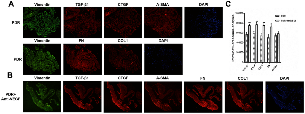 TGFβ1, CTGF, COL1, and FN were upregulated in the membrane after antiVEGF-treated. (A) TGFβ1, CTGF, α-SMA, FN and COL1 proliferative membrane immunofluorescence results in PDR patients without anti-VEGF treatment. (B) TGFβ1, CTGF, α-SMA, FN and COL1 proliferative membrane immunofluorescence results in PDR patients with anti-VEGF treatment. Vimentin, as an internal reference. DAPI, the tracer shows the nuclear position of the fluorescent agent 4',6-diamidino-2-phenylindole (magnification: ×10). (C) The levels of TGFβ1, CTGF, COL1, FN, and α-SMA were analyzed using ImageJ. Expression of TGFβ1, CTGF, COL1, and FN were significantly higher in the membranes obtained from antiVEGF-treated PDR patients than in the membranes obtained from untreated PDR patients. Data are expressed as mean ± SEM. * means P 