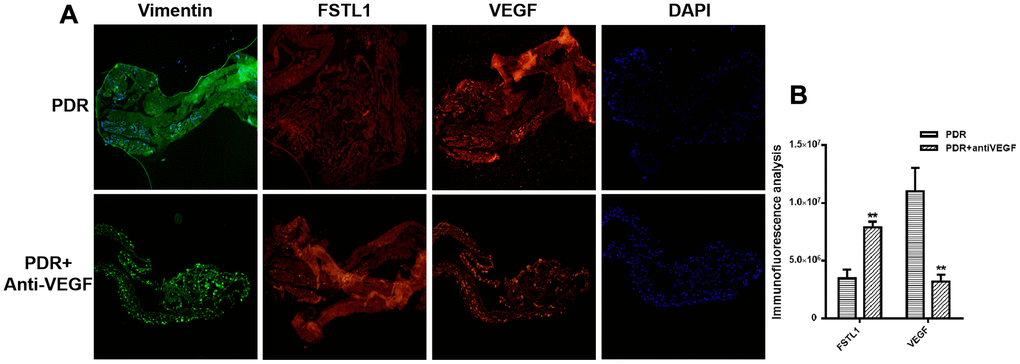 Stronger FSTL1 staining and weaker VEGF staining in the IVB-treated membranes. (A) FSTL1 and VEGF proliferative membrane immunofluorescence results in PDR patients with and without anti-VEGF treatment. Vimentin, as an internal reference. DAPI, the tracer shows the nuclear position of the fluorescent agent 4',6-diamidino-2-phenylindole (magnification: ×10). (B) The levels of FSTL1 and VEGF were analyzed using ImageJ. Stronger FSTL1 staining was detected in the IVB-treated membranes than in the untreated membranes, and VEGF staining was weaker in the IVB-treated group than in the untreated group. Data are expressed as mean ± SEM. * means P 