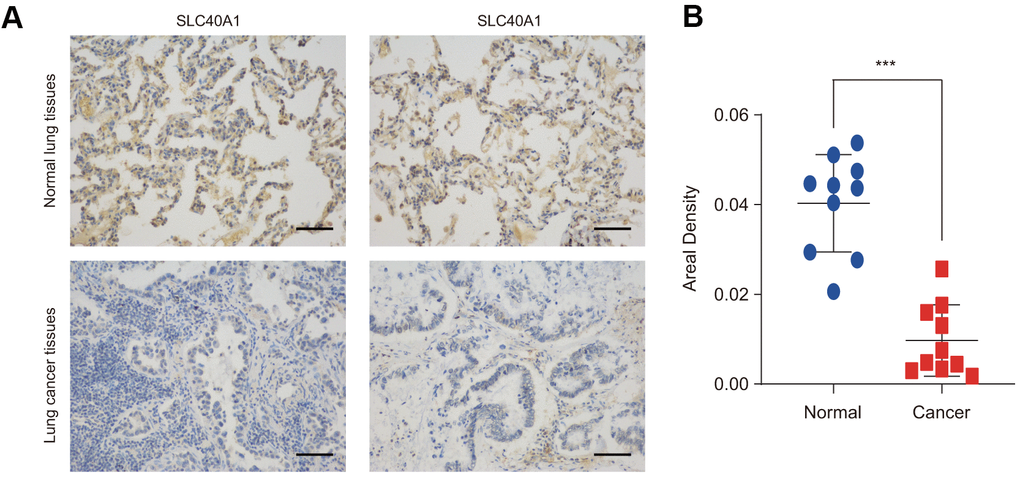 FPN1 expression at the protein level in lung cancer patients. (A) Immunohistochemical staining of FPN1 was performed in lung cancer and normal lung tissues. Representative images are shown. Scare bars, 50 μM. (B) The staining was quantified, as shown. The dot plot depicts the means and standard deviation of 10 images of normal lung tissues and 10 images of lung cancer patient tissues. ***p